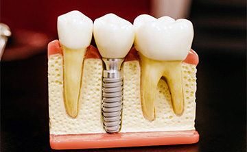 Slika implantata