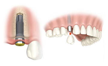 Slika implantata Slika implantata